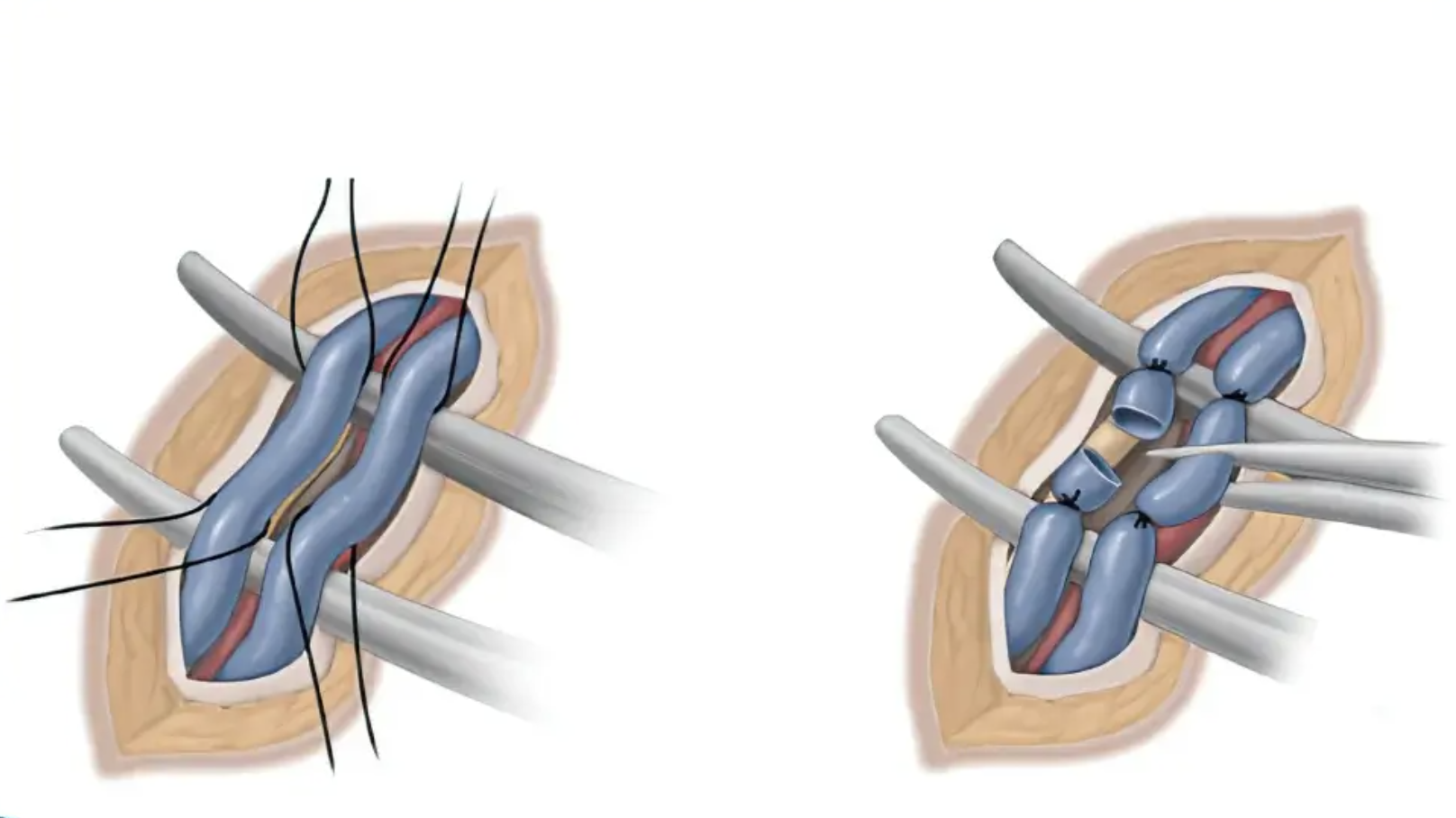 Varicocel embolization procedure diagram 4